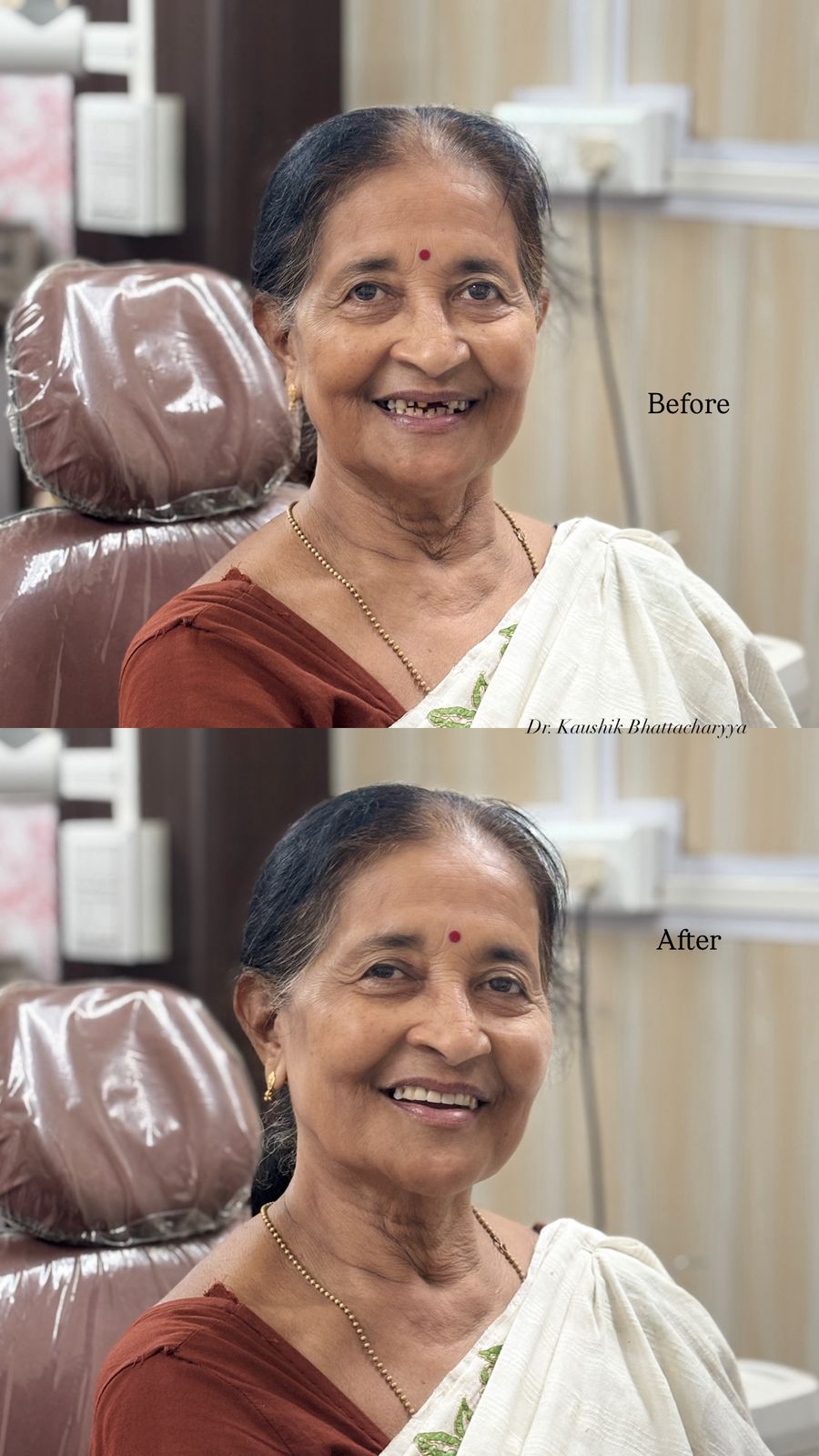 Before and after: Dentures & Implants